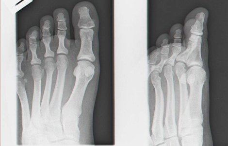 Piciorul descoperit intr-un bagaj pe aeroportul Otopeni ar putea fi de urs