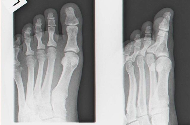 Piciorul descoperit intr-un bagaj pe aeroportul Otopeni ar putea fi de urs