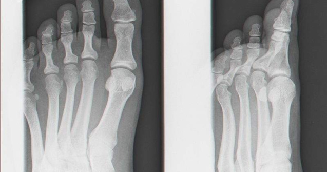 Piciorul descoperit intr-un bagaj pe aeroportul Otopeni ar putea fi de urs