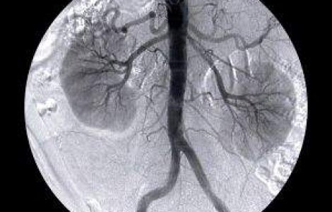  Video  Incredibil! Si-a vandut rinichiul pentru un iPad