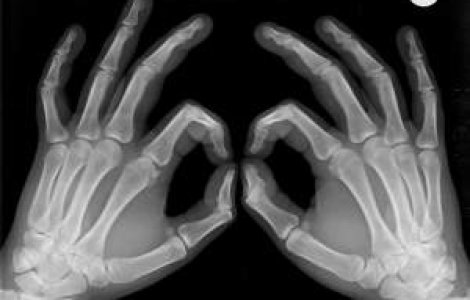 O noua metoda de detectare a osteoporozei, de la astronauti