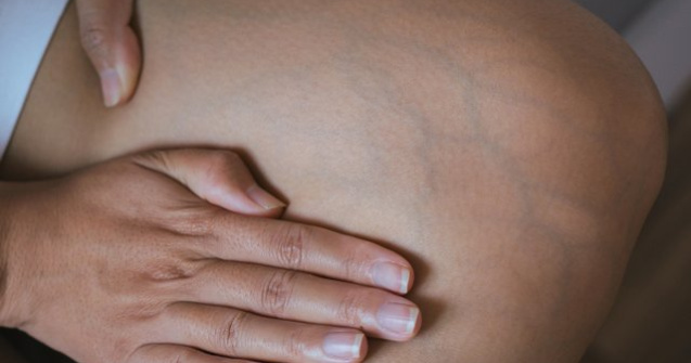 Chirurg: Pacientul cu varice poate face accident vascular cerebral sau infarct miocardic