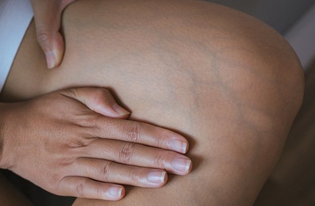 Chirurg: Pacientul cu varice poate face accident vascular cerebral sau infarct miocardic