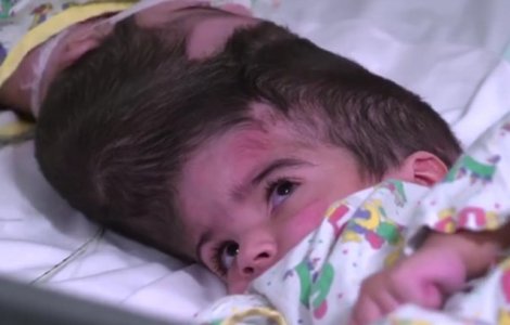 Siameze cu craniile si creierele unite au fost separate cu succes de chirurgi/ VIDEO