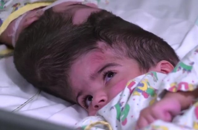 Siameze cu craniile si creierele unite au fost separate cu succes de chirurgi/ VIDEO