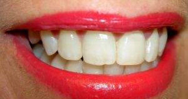 Gata cu vizitele la dentist: S-a inventat molecula "anti-carii"