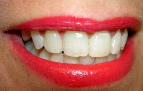 Gata cu vizitele la dentist: S-a inventat molecula "anti-carii"