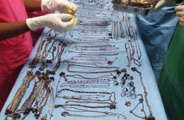 India: 1.6 kilograme de bijuterii, scoase de medici din stomacul unei femei