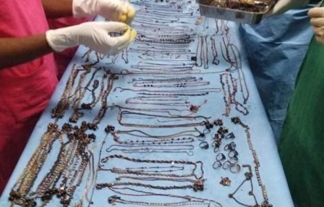 Medicii au scos 1.6 kilograme de bijuterii din stomacul unei femei