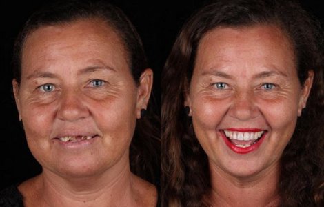  Top  Un dentist bun reda zambetul pe chipul oricui: 10+ transformari ale unor oameni saraci, acum cu dantura perfecta