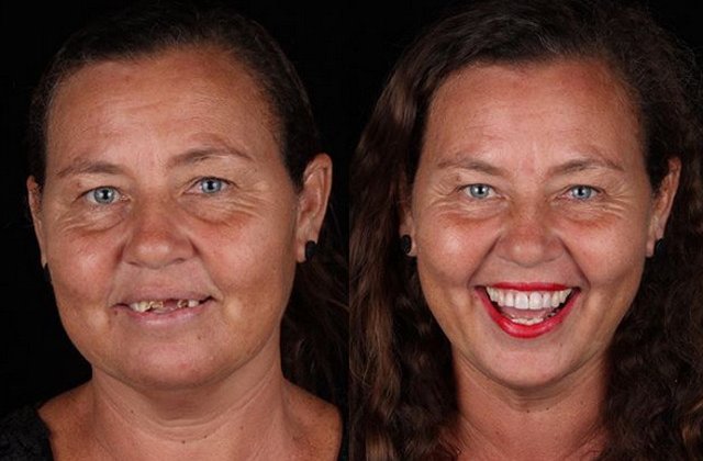 Un dentist bun reda zambetul pe chipul oricui: 10+ transformari ale unor oameni saraci, acum cu dantura perfecta