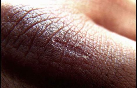 A fost descoperita pielea artificiala