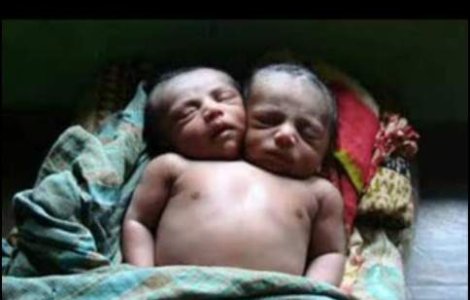 VIDEO: Bebelus cu 2 capete, nascut in Filipine