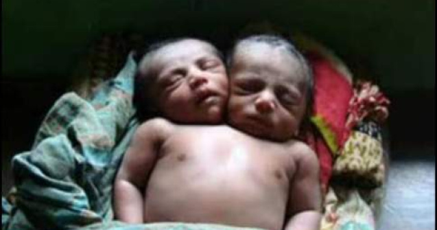 VIDEO: Bebelus cu 2 capete, nascut in Filipine