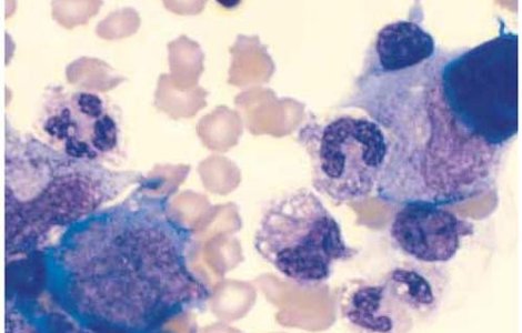 Sistemul imunitar al oamenilor protejeaza celulele canceroase