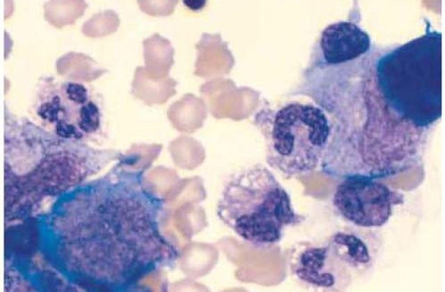 Sistemul imunitar al oamenilor protejeaza celulele canceroase