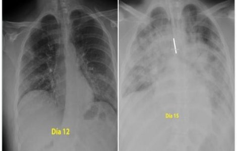 FOTO: Așa arată plămânii unei persoane infectate cu noul coronavirus