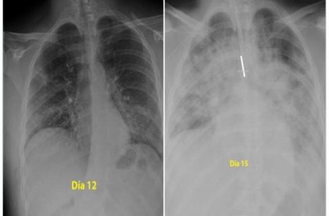 FOTO: Așa arată plăm&acirc;nii unei persoane infectate cu noul coronavirus