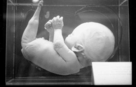 Copil sirena nascut in Brasov