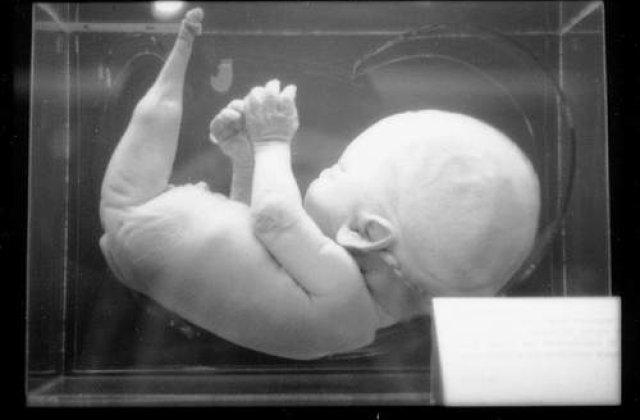 Copil sirena nascut in Brasov