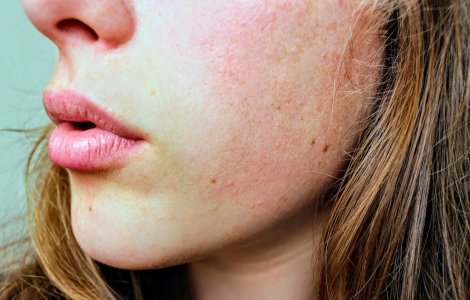 Urticaria - de ce apare şi cum o tratezi. Metode naturale de ameliorare