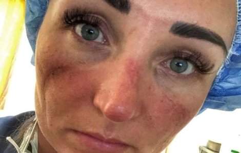 Așa arată fața unui medic care luptă în prima linie cu noul coronavirus