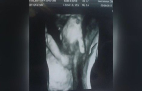 Făt bolnav, surprins la ecograf în timp ce strângea mâna surorii sale gemene