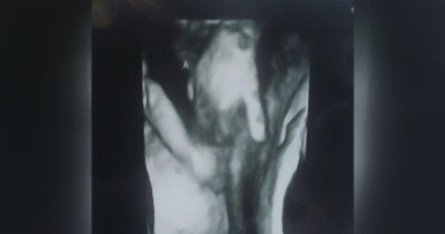 Făt bolnav, surprins la ecograf în timp ce strângea mâna surorii sale gemene