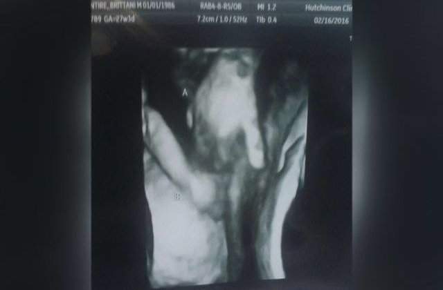 Făt bolnav, surprins la ecograf în timp ce strângea mâna surorii sale gemene