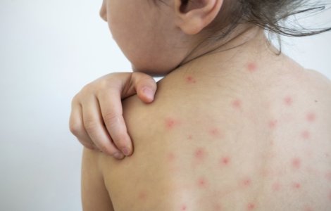 Epidemia care face ravagii: România are peste 20.000 de cazuri de rujeolă