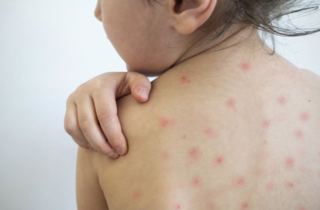 Epidemia care face ravagii necontrolată: Rom&acirc;nia are peste 20.000 de cazuri de rujeolă