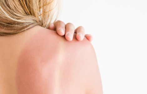  Top  Arsurile solare: 6 remedii care funcționează și 4 pe care să le eviți