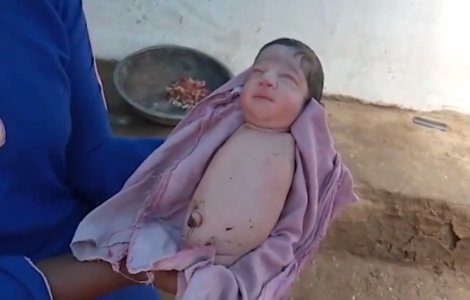 VIDEO O fetiță s-a născut fără mâini și fără picioare. Medicii sunt uimiți