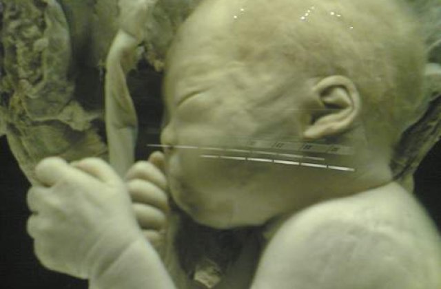 Fetita insarcinata cu fratele geaman, operata cu succes