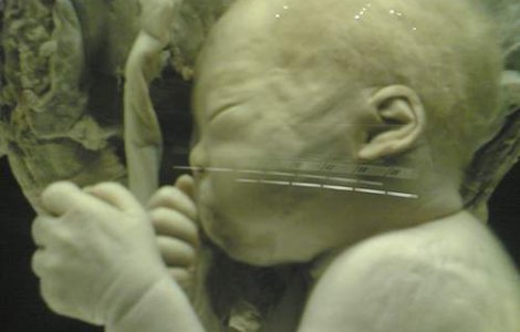 Fetita insarcinata cu fratele geaman, operata cu succes