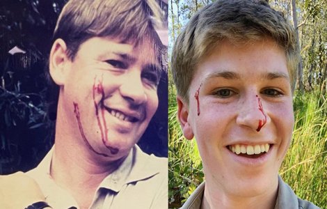 FOTO Fiul lui Steve Irwin a fost mușcat de un șarpe