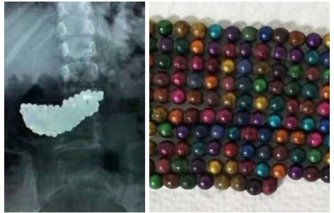 O fetiță de 5 ani a înghițit 190 de bile metalice când se juca