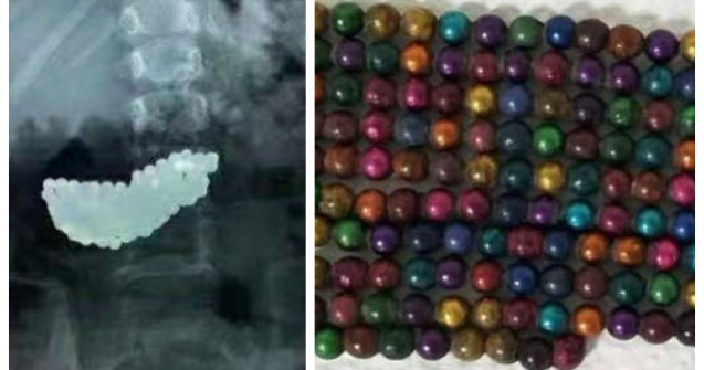 O fetiță de 5 ani a înghițit 190 de bile metalice când se juca