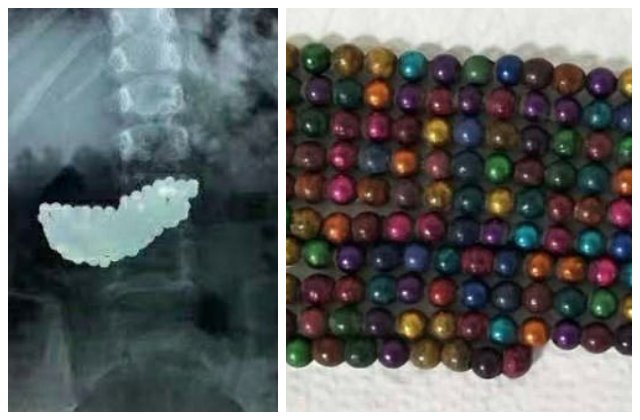 O fetiță de 5 ani a înghițit 190 de bile metalice când se juca. De ce nu au dus-o părinții la spital