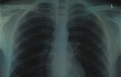 A trait 68 de ani cu un glont in plaman