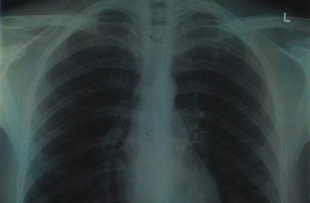 A trait 68 de ani cu un glont in plaman