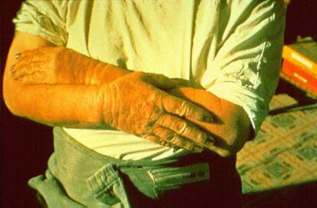 Alergic la propria nevasta