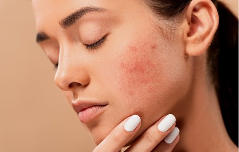  Top  Optează pentru tratamentul natural: 7 alimente care vor reduce cicatricile acneei