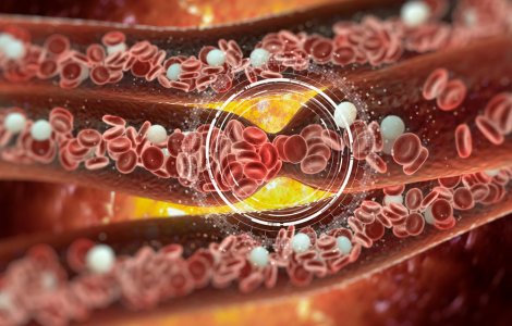  Top  10 moduri de a preveni cheagurile de sânge care ne pot pune viața în pericol