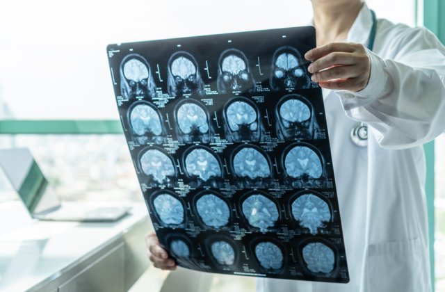 Accidente vasculare cerebrale - cauze și persoanele predispuse. Medic: „Atenţie la ce şi cât mâncaţi de sărbători!”