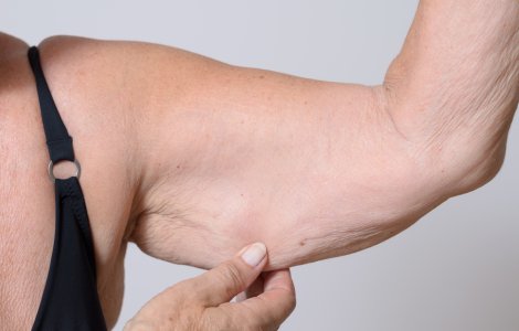  Top  4 moduri prin care poți elimina pielea lăsată după ce ai slăbit