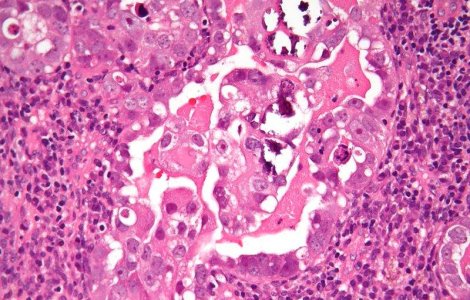 Romania, premiata pentru proiectele de prevenire a cancerului de col uterin