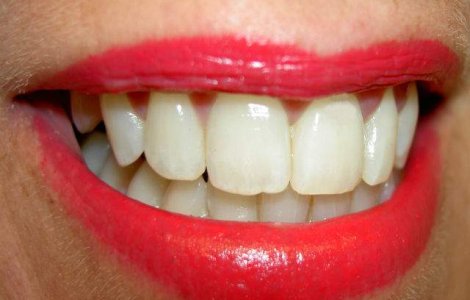 Un senzor implantat intr-un dinte ar putea monitoriza excesele