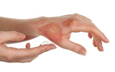 Calmează arsurile de piele: 3...