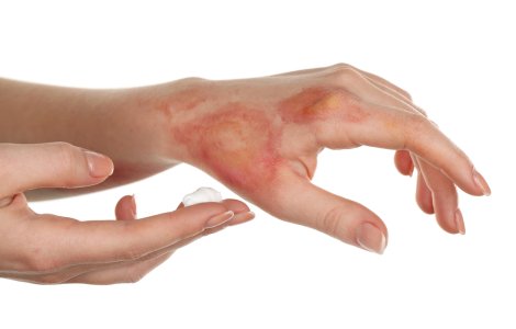  Top  Calmează arsurile de piele: 3 metode de a trata arsurile în condiții casnice